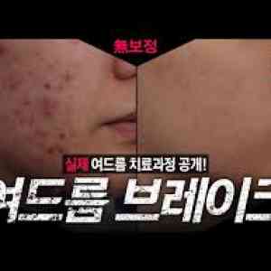 Images Overcome severe acne Actual acne treatment process revealed 